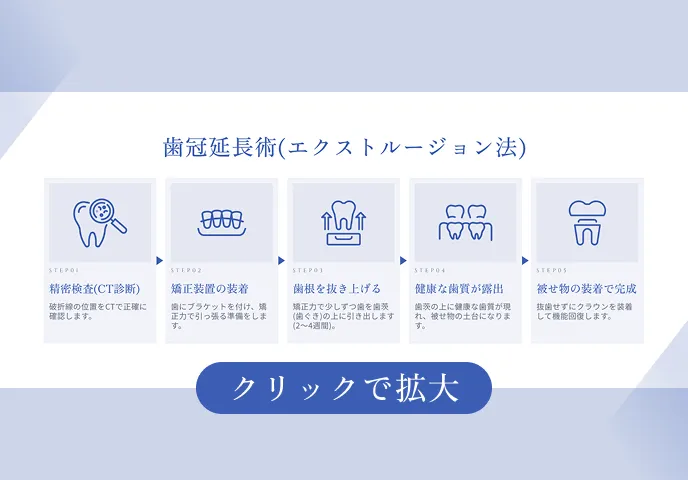 歯冠延長術（エクストルージョン法）の治療フロー｜東京都歯根破折治療