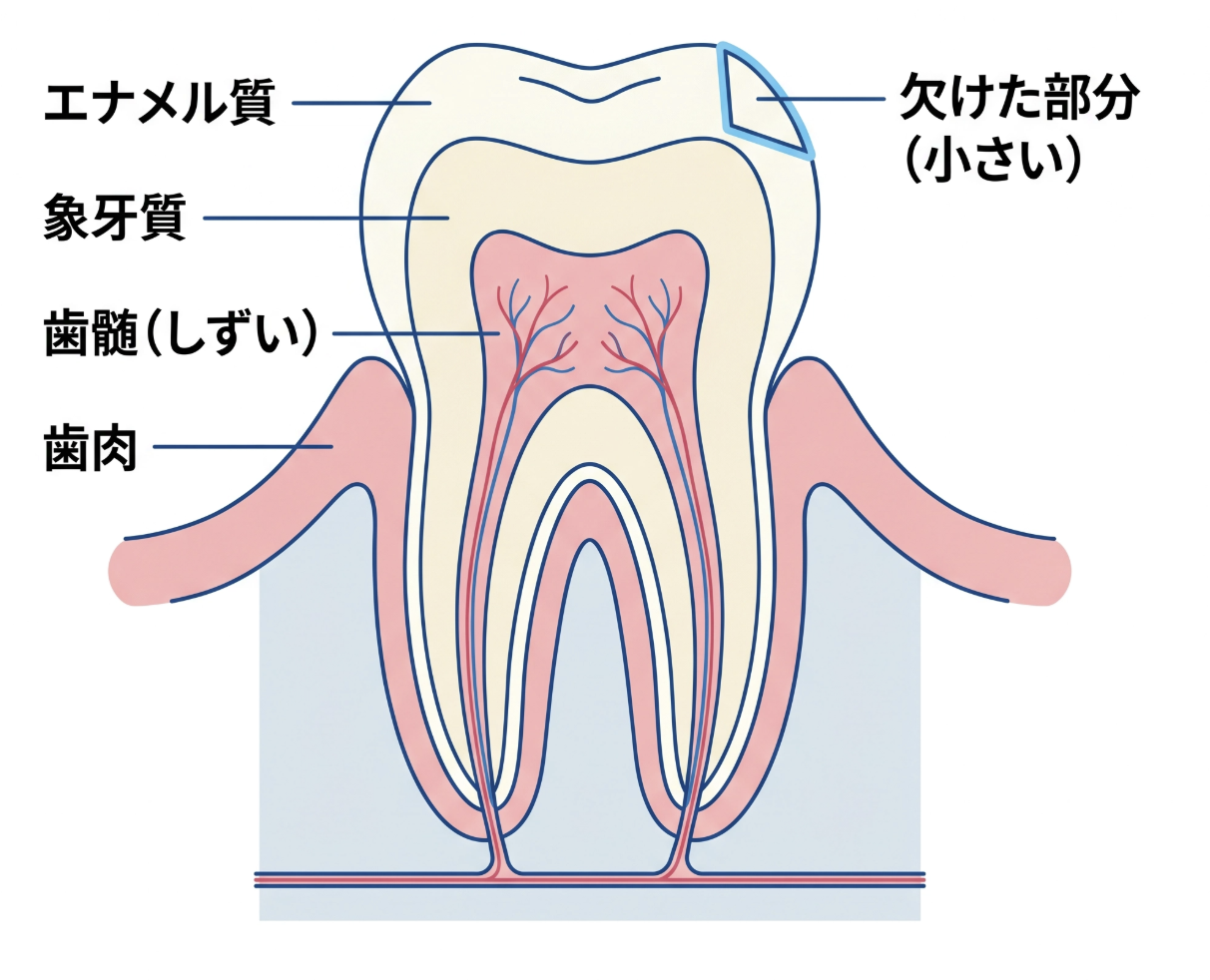 コンポジットレジン修復