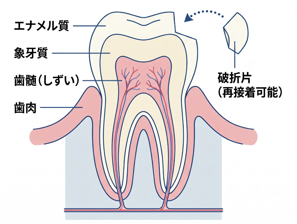 破折片の接着修復