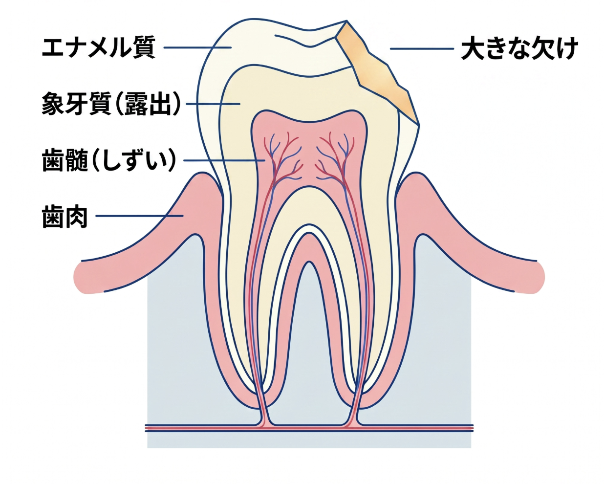 ラミネートベニア修復