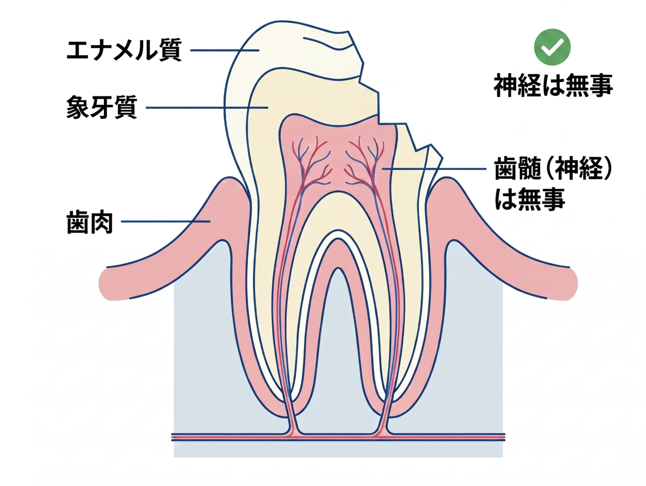 セラミッククラウン修復