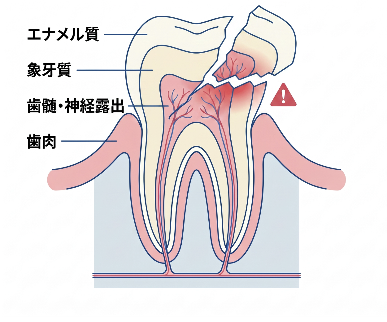 土台（コア）＋セラミッククラウン