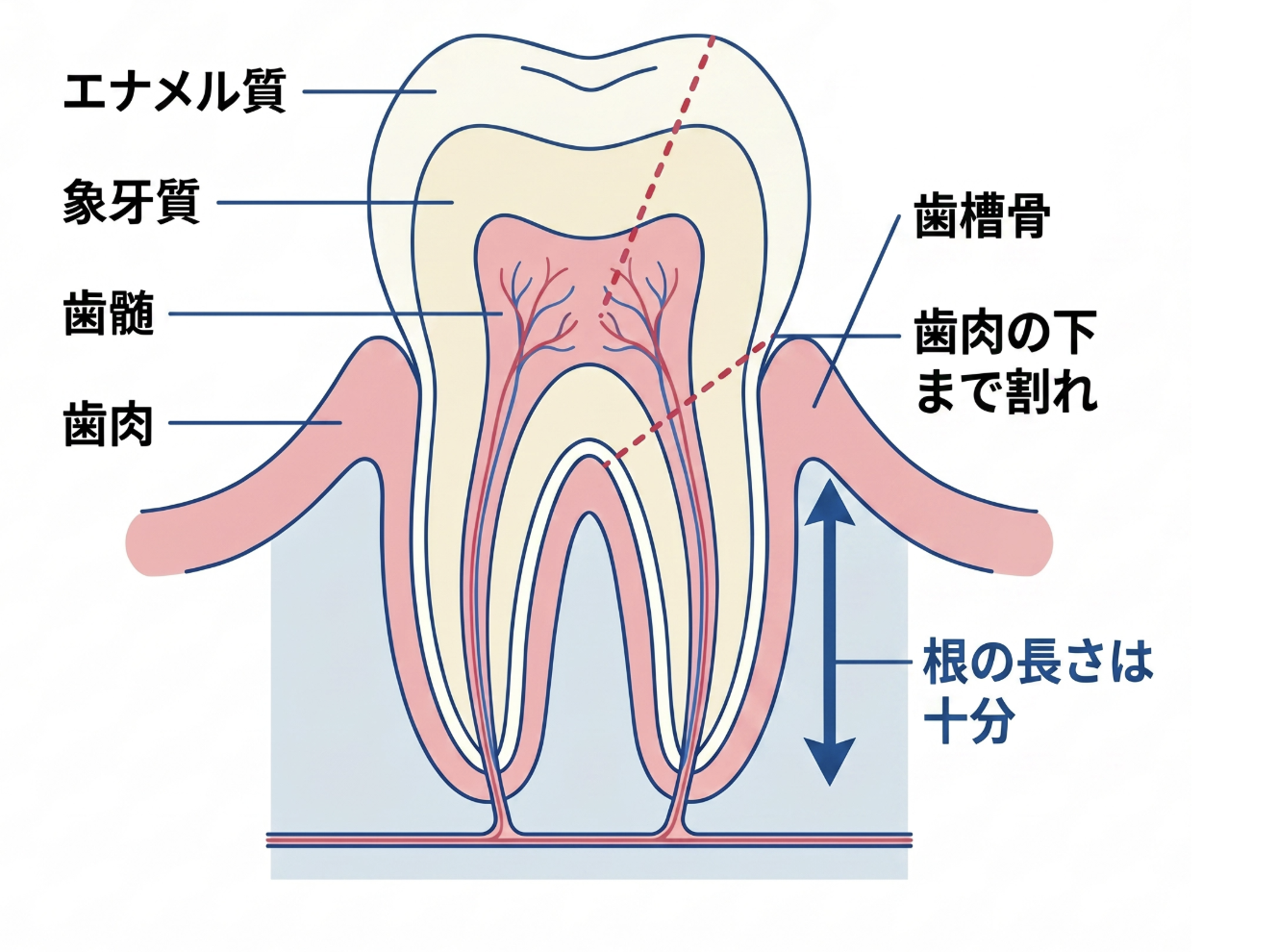 歯冠長延長術＋土台＋クラウン
